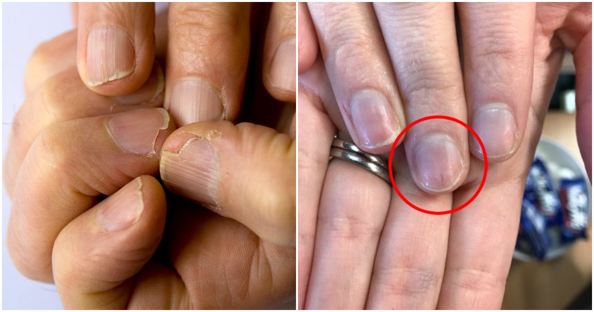 Nails and health: This is what yellowed nails and 'nail clubbing' means.