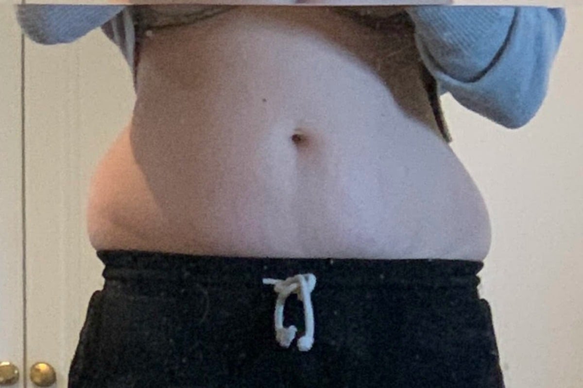 best tummy tuck near me