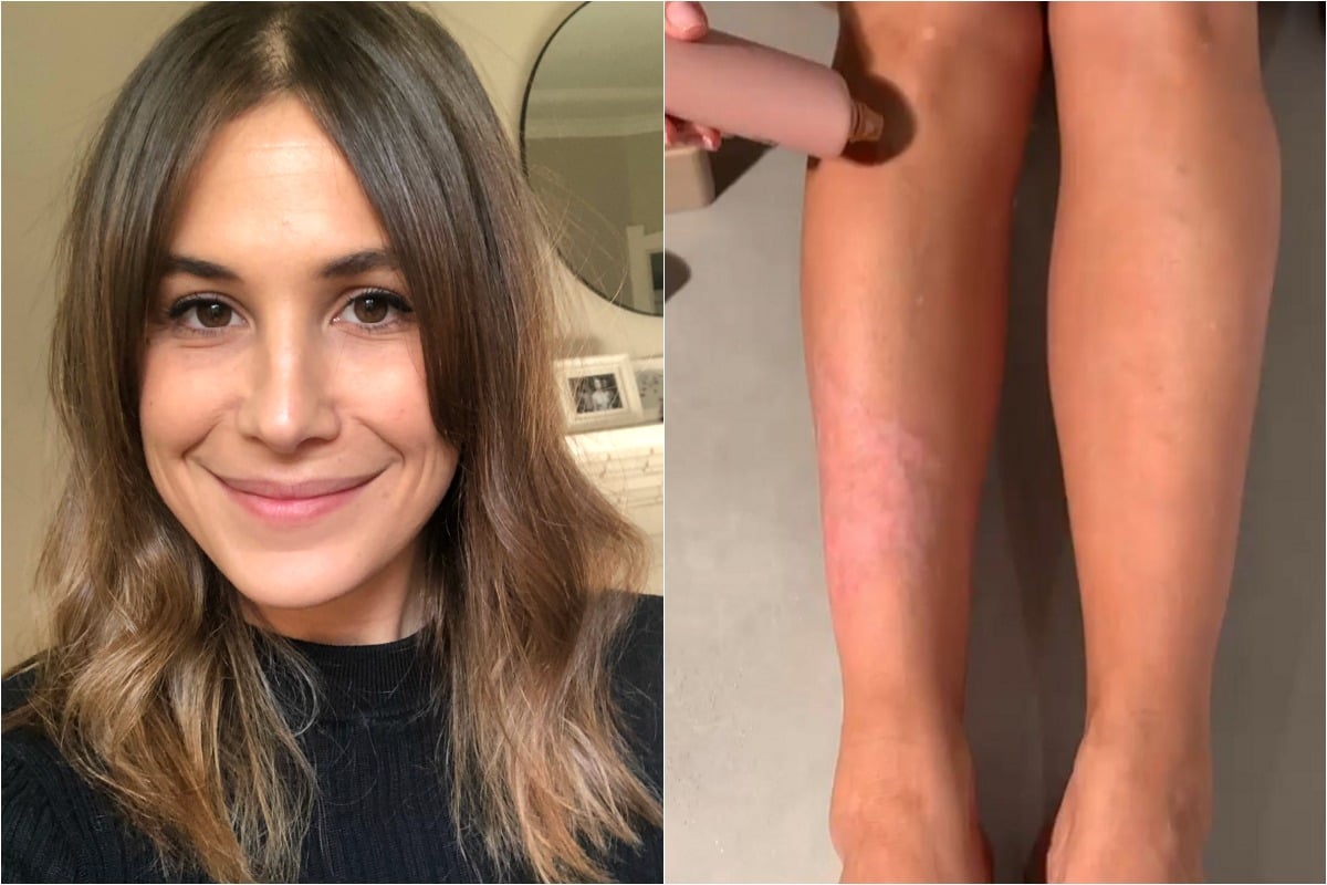 Is Kim Kardashian West's method of using body makeup on psoriasis safe?