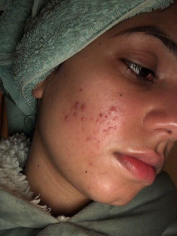 microneedling before and after