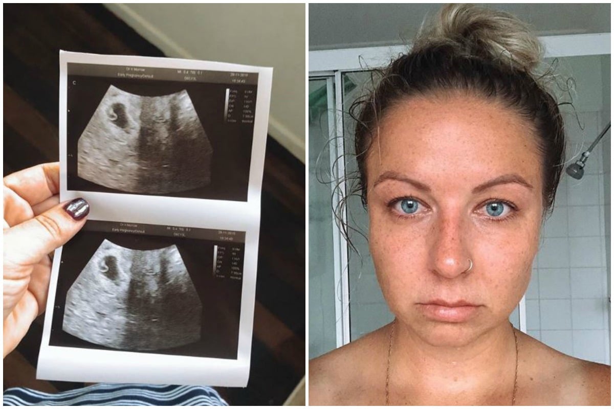 The Uncensored Reality Of What A Miscarriage Looks Like